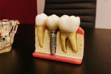 Dinti ficsi in 24 de ore? Care sunt etapele si avantajele implantului dentar Fast & Fixed?