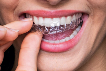 Aparat dentar – tipuri, avantaje si dezavantaje