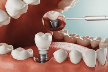 Înlocuirea dinților pierduți cu implanturi dentare – Un pas important pentru sănătatea și starea ta de bine.