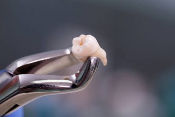 Extracția molarilor: Procedură, motive și recuperare