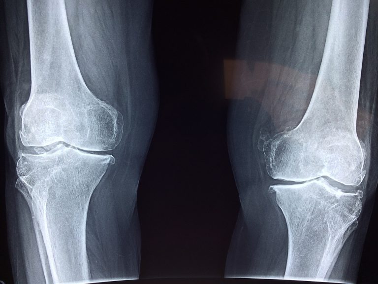 bones and joints