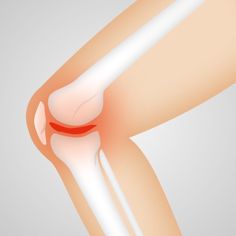 osteoarthritis